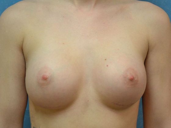 Breast Augmentation Case 1364- Ottawa Lake, MI - After
