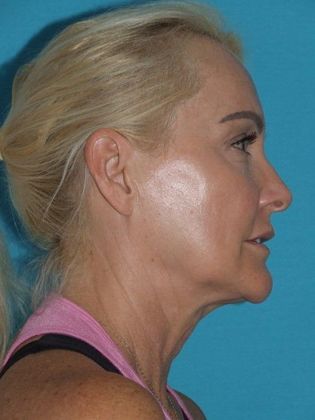 Mini Facelift: Case 10 - Before