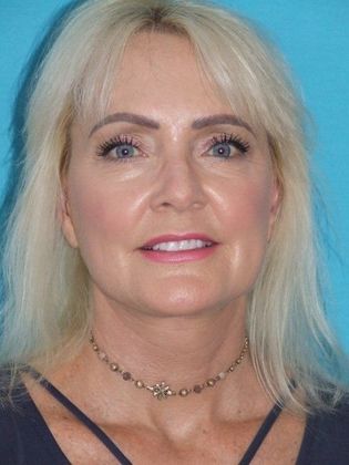 Mini Facelift: Case 10 - Before