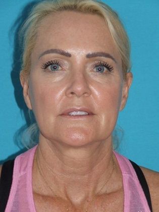 Mini Facelift: Case 10 - Before