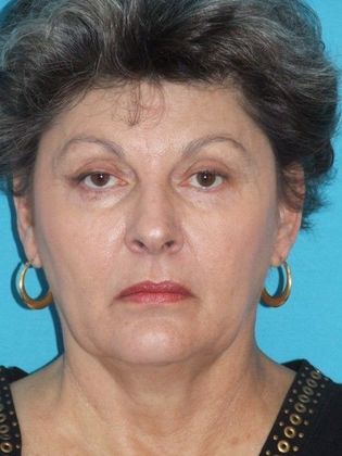 Mini Facelift Case 11 - Before