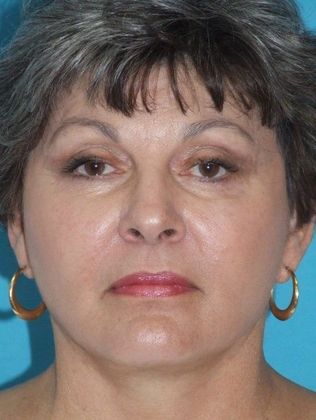 Mini Facelift Case 11 - After