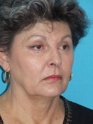 Mini Facelift: Case 11 - Before