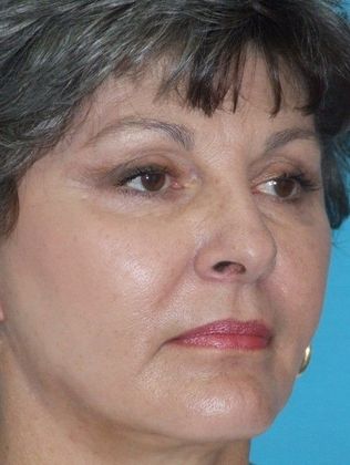 Mini Facelift: Case 11 - After