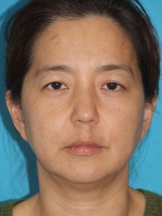 Mini Facelift Case 12 - Before