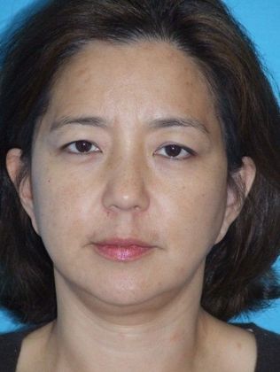 Mini Facelift Case 12 - After