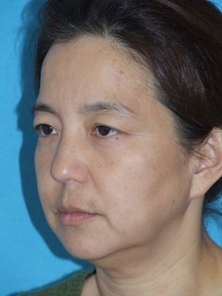 Mini Facelift: Case 12 - Before