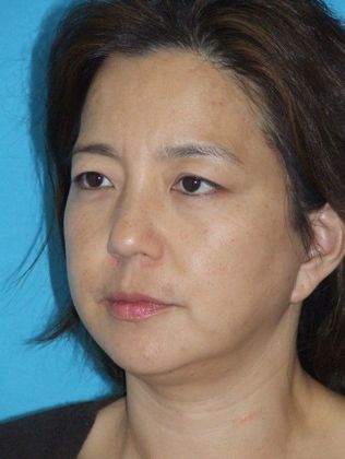 Mini Facelift: Case 12 - After