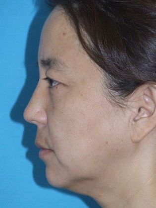Mini Facelift: Case 12 - Before