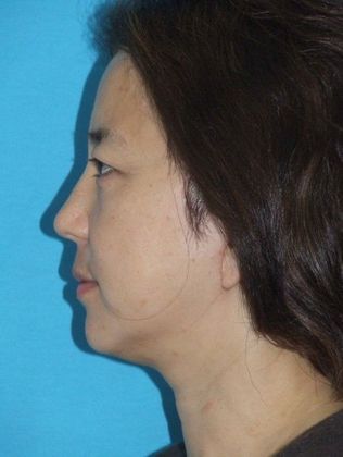 Mini Facelift: Case 12 - After