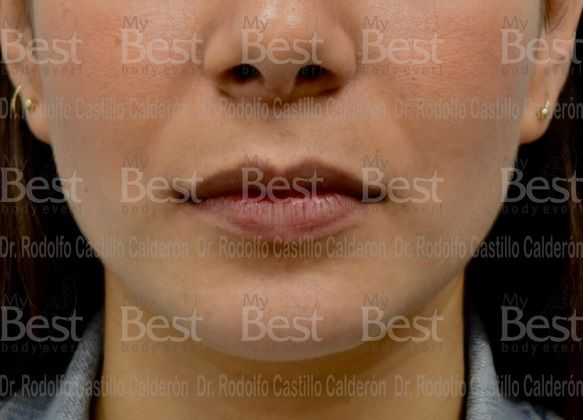 Chin augmentation: Rhinoplasty with chin augmentation - After