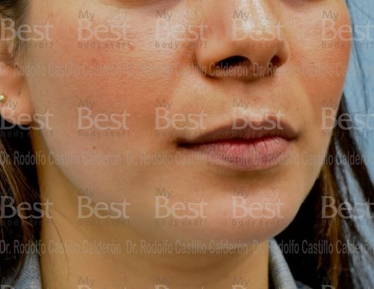 Chin augmentation: Rhinoplasty with chin augmentation - After
