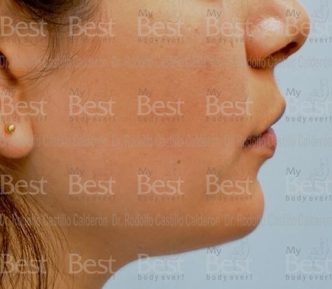 Chin augmentation Rhinoplasty with chin augmentation - After