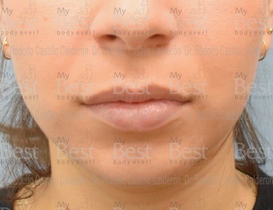 Chin augmentation: Rhinoplasty with chin augmentation - Before