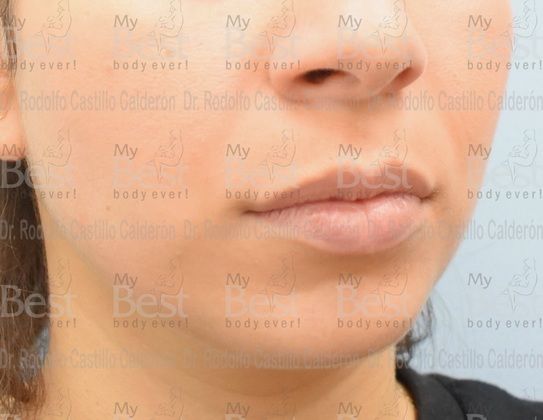 Chin augmentation: Rhinoplasty with chin augmentation - Before