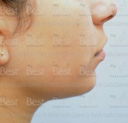 Chin augmentation Rhinoplasty with chin augmentation - Before