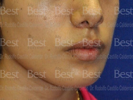 Chin augmentation Chin Implant and Rhinoplasty  - After