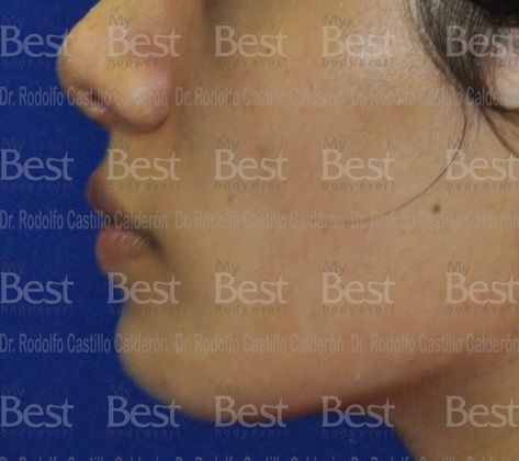 Chin augmentation: Chin Implant and Rhinoplasty - After