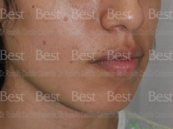 Chin augmentation Chin Implant and Rhinoplasty  - Before