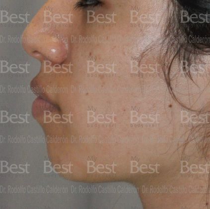Chin augmentation: Chin Implant and Rhinoplasty - Before