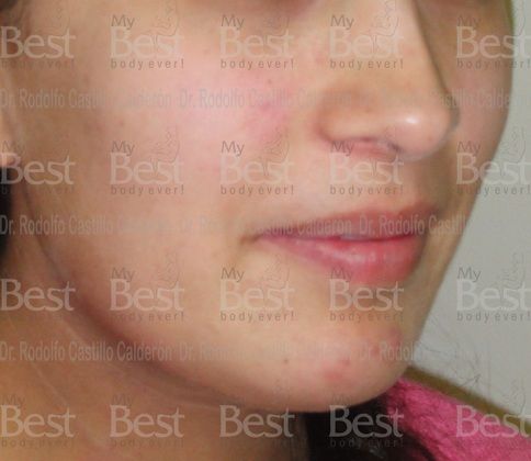 Chin augmentation: Rhinoplasty and chin augmentation - After