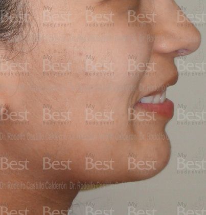 Chin augmentation: Rhinoplasty and chin augmentation - After