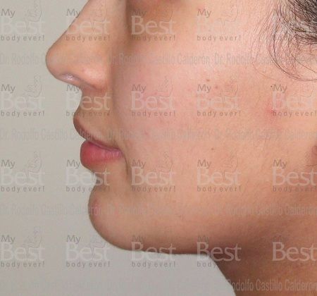 Chin augmentation Rhinoplasty and chin augmentation - After