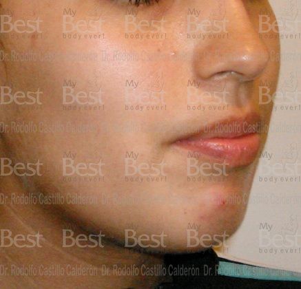 Chin augmentation: Rhinoplasty and chin augmentation - Before