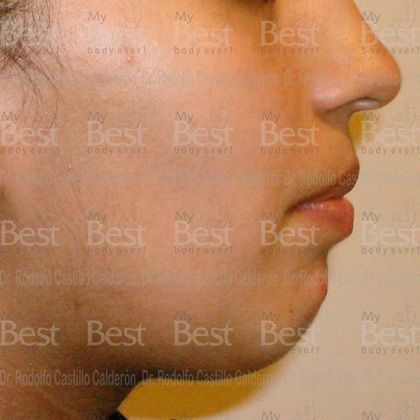 Chin augmentation: Rhinoplasty and chin augmentation - Before