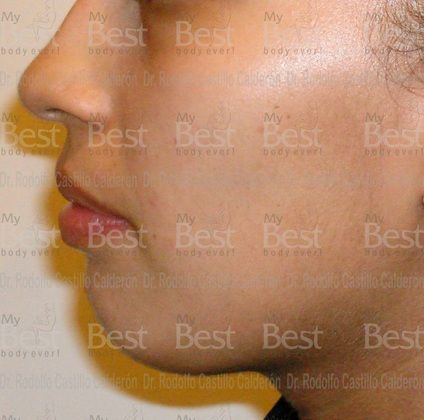 Chin augmentation Rhinoplasty and chin augmentation - Before