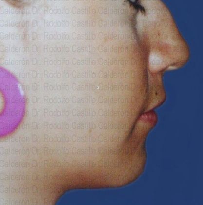 Chin augmentation: Combination Rhinoplasty-Mentoplasty - Before