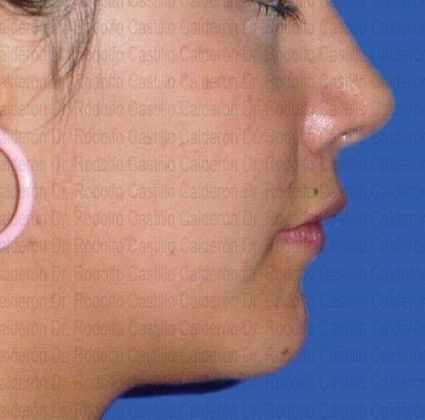 Chin augmentation: Combination Rhinoplasty-Mentoplasty - After