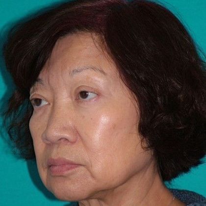 Mini Facelift: Case 13 - Before