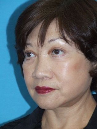 Mini Facelift: Case 13 - After