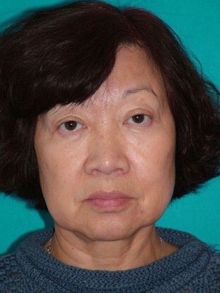 Mini Facelift Case 13 - Before