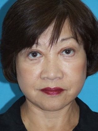 Mini Facelift Case 13 - After