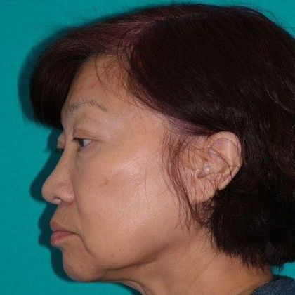 Mini Facelift: Case 13 - Before