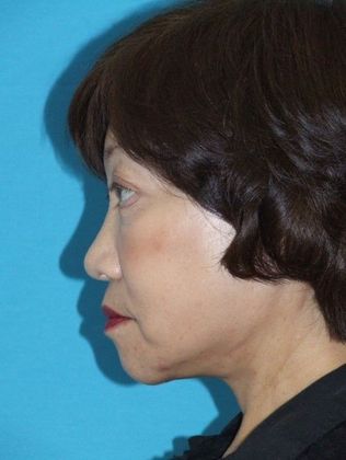 Mini Facelift: Case 13 - After