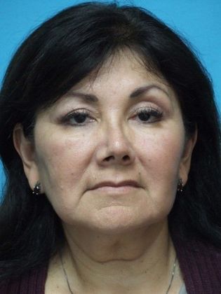 Mini Facelift Case 14 - Before