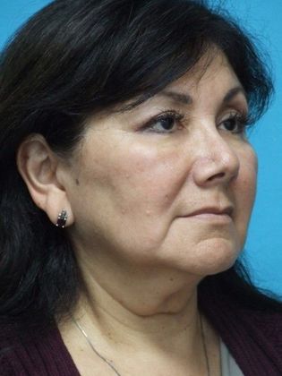 Mini Facelift: Case 14 - Before