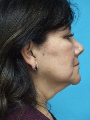Mini Facelift: Case 14 - Before