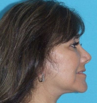 Mini Facelift: Case 14 - After