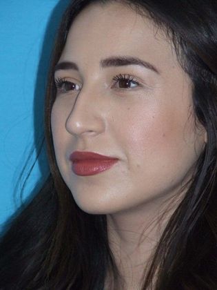 Rhinoplasty Case 2 - Before