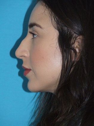 Rhinoplasty: Case 2 - Before