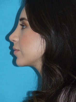 Rhinoplasty: Case 2 - After