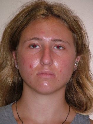 Rhinoplasty: Case 3 - Before