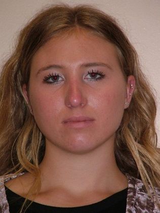 Rhinoplasty: Case 3 - After