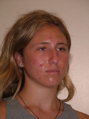 Rhinoplasty: Case 3 - After