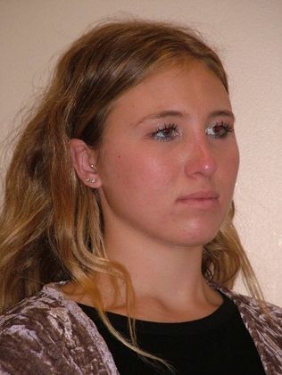 Rhinoplasty: Case 3 - Before