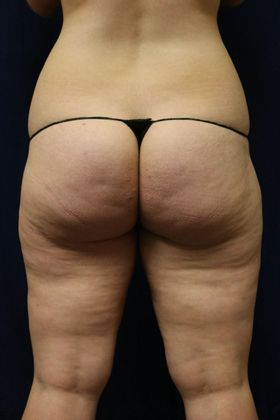 Liposuction & Safe Lipo: Case 33 - Before
